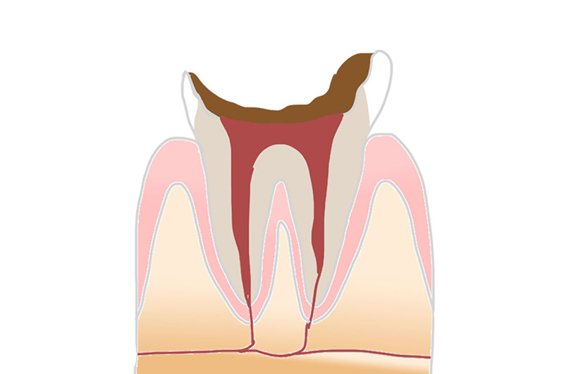 C4（歯根の虫歯）